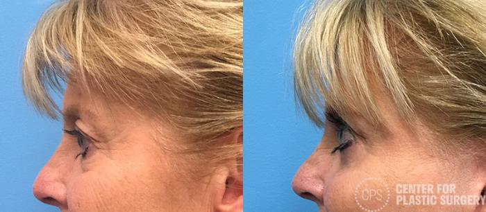 Eyelid Surgery Case 20 Before & After Left Side | Chevy Chase & Annandale, Washington D.C. Metropolitan Area | Center for Plastic Surgery