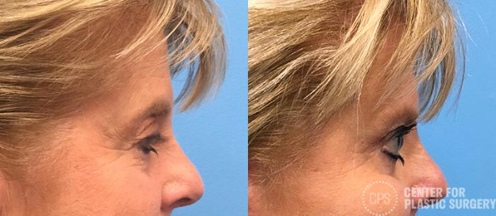 Eyelid Surgery Case 20 Before & After Right Side | Chevy Chase & Annandale, Washington D.C. Metropolitan Area | Center for Plastic Surgery