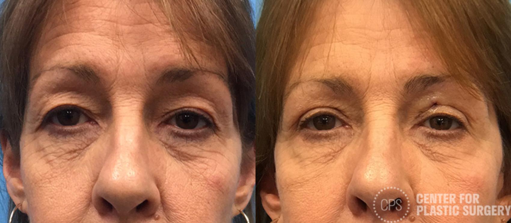 Eyelid Surgery Case 21 Before & After Front | Chevy Chase & Annandale, Washington D.C. Metropolitan Area | Center for Plastic Surgery