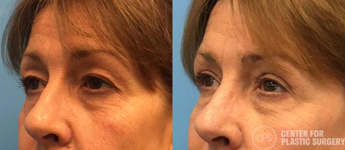 Eyelid Surgery Case 21 Before & After Left Oblique | Chevy Chase & Annandale, Washington D.C. Metropolitan Area | Center for Plastic Surgery