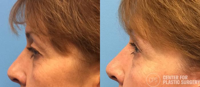 Eyelid Surgery Case 21 Before & After Left Side | Chevy Chase & Annandale, Washington D.C. Metropolitan Area | Center for Plastic Surgery