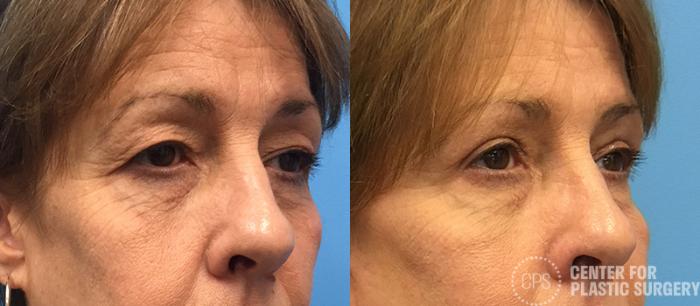 Eyelid Surgery Case 21 Before & After Right Oblique | Chevy Chase & Annandale, Washington D.C. Metropolitan Area | Center for Plastic Surgery