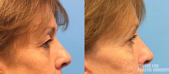 Eyelid Surgery Case 21 Before & After Right Side | Chevy Chase & Annandale, Washington D.C. Metropolitan Area | Center for Plastic Surgery