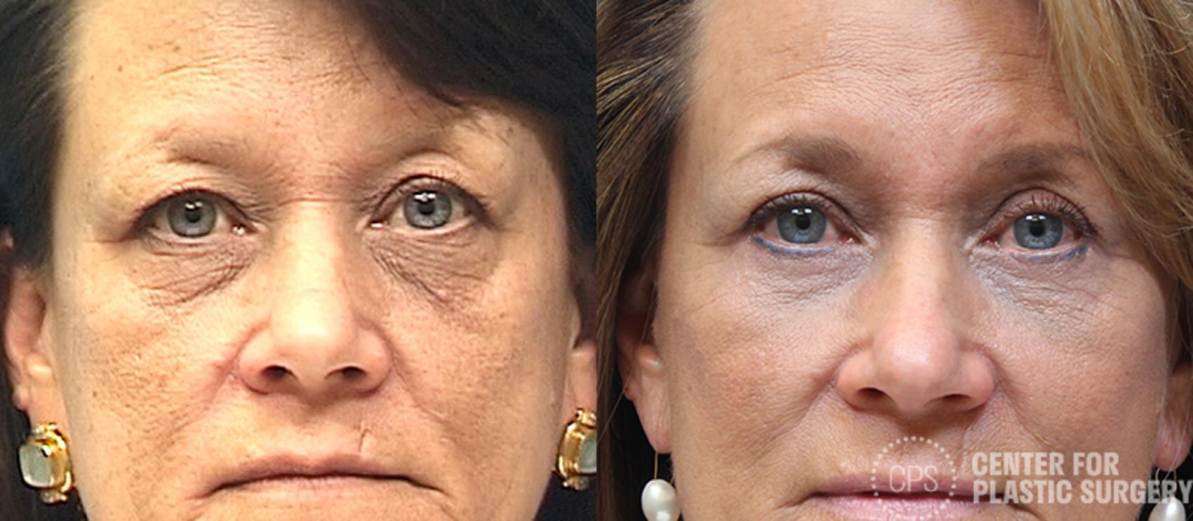 Eyelid Surgery Case 22 Before & After Front | Chevy Chase & Annandale, Washington D.C. Metropolitan Area | Center for Plastic Surgery
