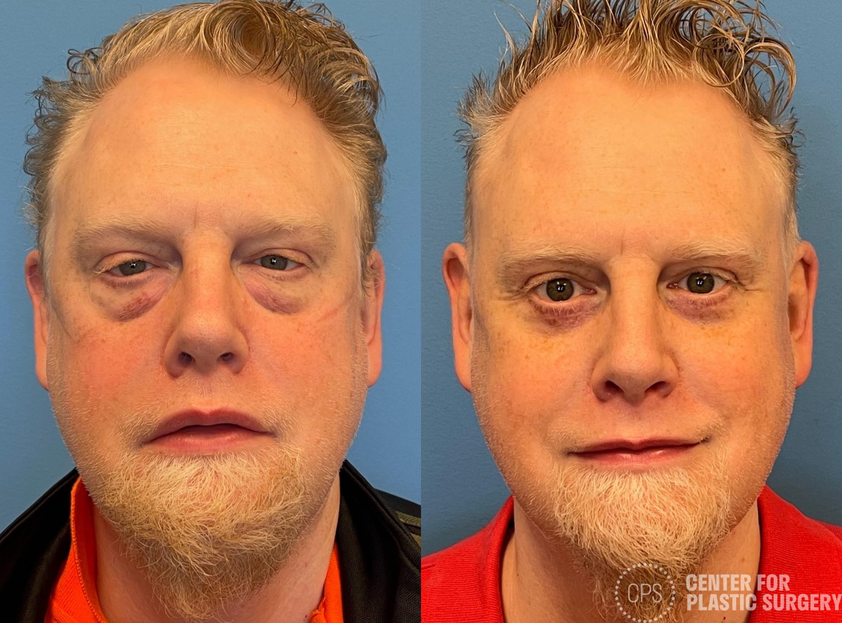 Eyelid Surgery Case 289 Before & After Front | Chevy Chase & Annandale, Washington D.C. Metropolitan Area | Center for Plastic Surgery