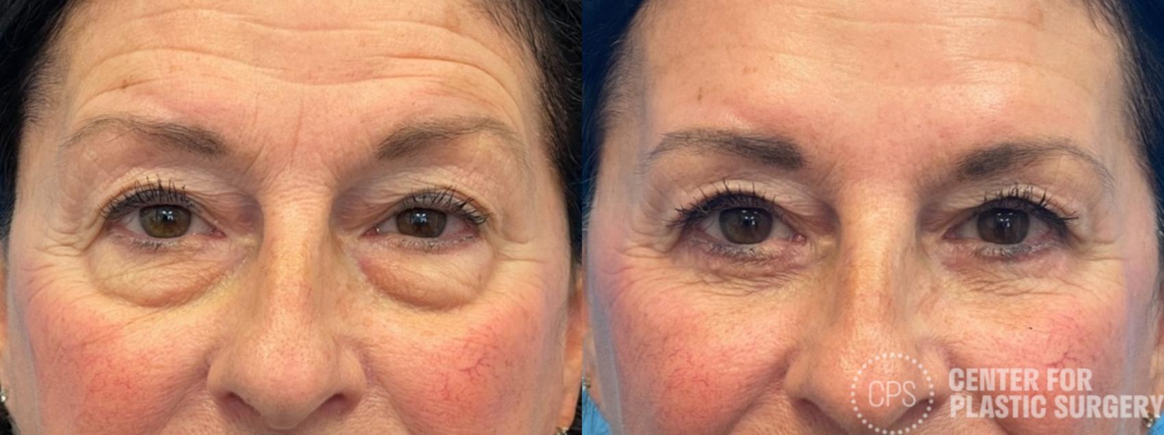 Eyelid Surgery Case 290 Before & After Front | Chevy Chase & Annandale, Washington D.C. Metropolitan Area | Center for Plastic Surgery