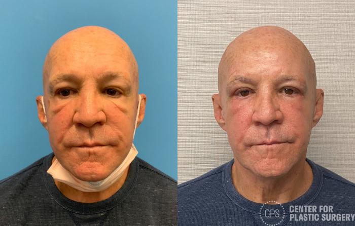 Eyelid Surgery Case 329 Before & After Front | Chevy Chase & Annandale, Washington D.C. Metropolitan Area | Center for Plastic Surgery