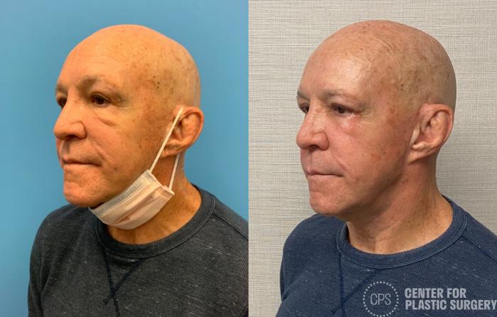 Eyelid Surgery Case 329 Before & After Left Oblique | Chevy Chase & Annandale, Washington D.C. Metropolitan Area | Center for Plastic Surgery