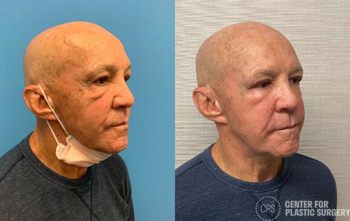 Eyelid Surgery Case 329 Before & After Right Oblique | Chevy Chase & Annandale, Washington D.C. Metropolitan Area | Center for Plastic Surgery