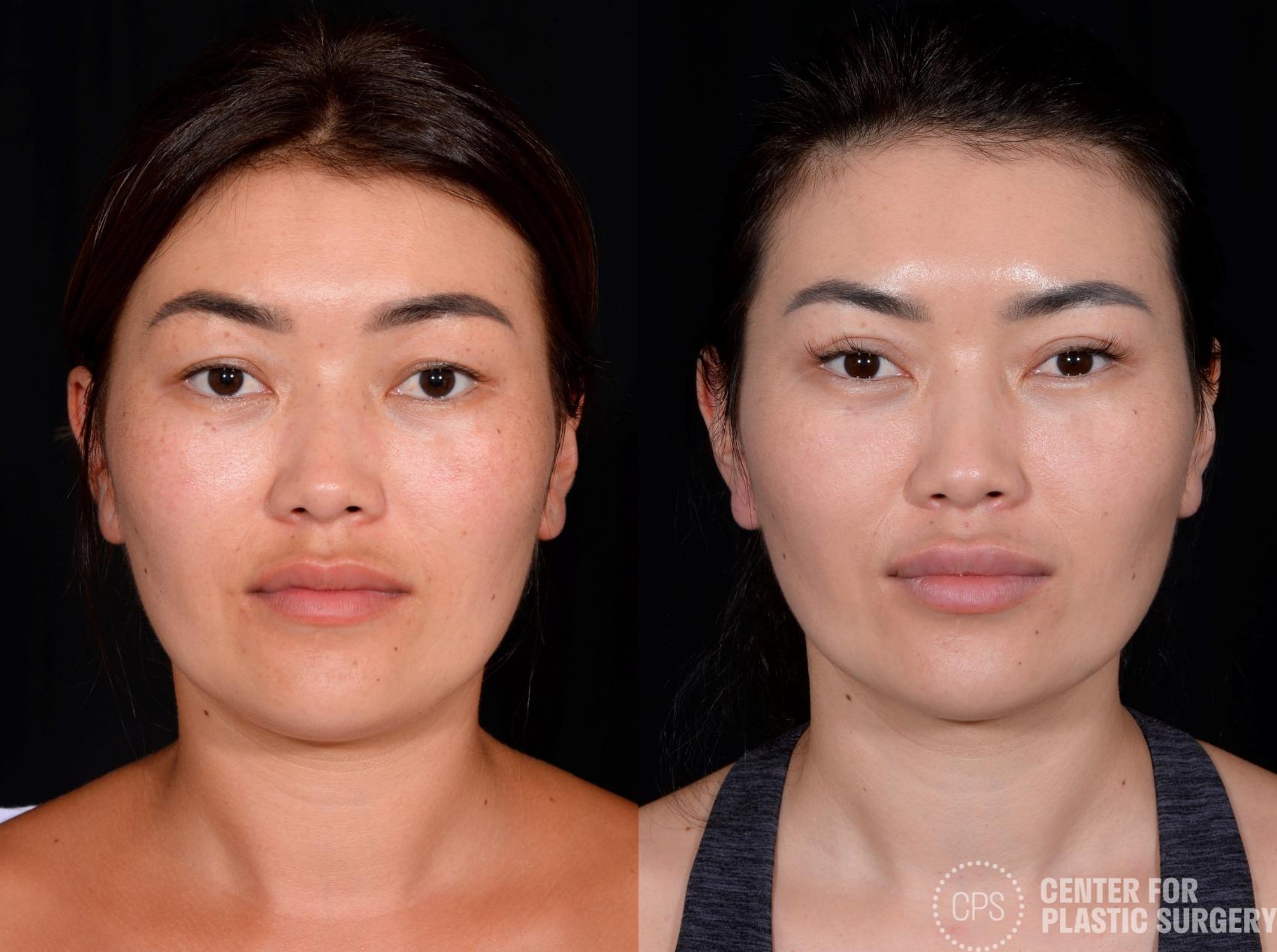 Eyelid Surgery Case 356 Before & After Front | Chevy Chase & Annandale, Washington D.C. Metropolitan Area | Center for Plastic Surgery