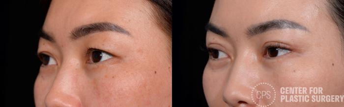 Eyelid Surgery Case 356 Before & After Left Oblique | Chevy Chase & Annandale, Washington D.C. Metropolitan Area | Center for Plastic Surgery