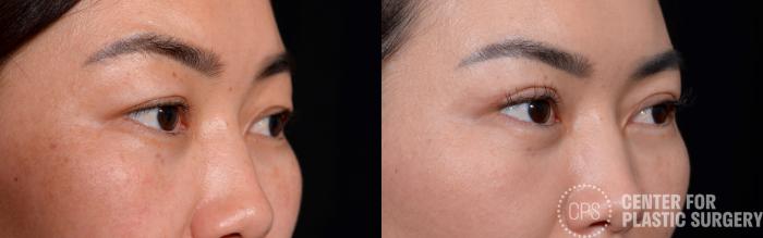 Eyelid Surgery Case 356 Before & After Right Oblique | Chevy Chase & Annandale, Washington D.C. Metropolitan Area | Center for Plastic Surgery