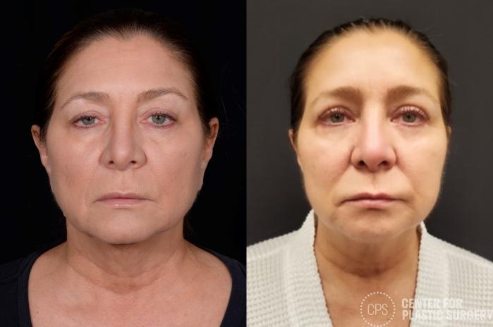 Eyelid Surgery Case 358 Before & After Front | Chevy Chase & Annandale, Washington D.C. Metropolitan Area | Center for Plastic Surgery