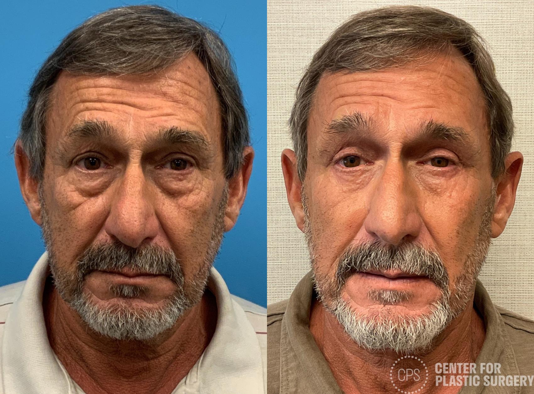 Eyelid Surgery Case 402 Before & After Front | Chevy Chase & Annandale, Washington D.C. Metropolitan Area | Center for Plastic Surgery
