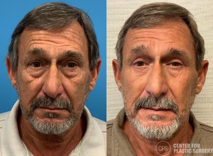Eyelid Surgery Case 402 Before & After Front | Chevy Chase & Annandale, Washington D.C. Metropolitan Area | Center for Plastic Surgery