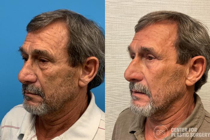 Eyelid Surgery Case 402 Before & After Left Oblique | Chevy Chase & Annandale, Washington D.C. Metropolitan Area | Center for Plastic Surgery