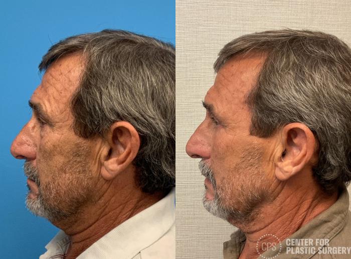 Eyelid Surgery Case 402 Before & After Left Side | Chevy Chase & Annandale, Washington D.C. Metropolitan Area | Center for Plastic Surgery