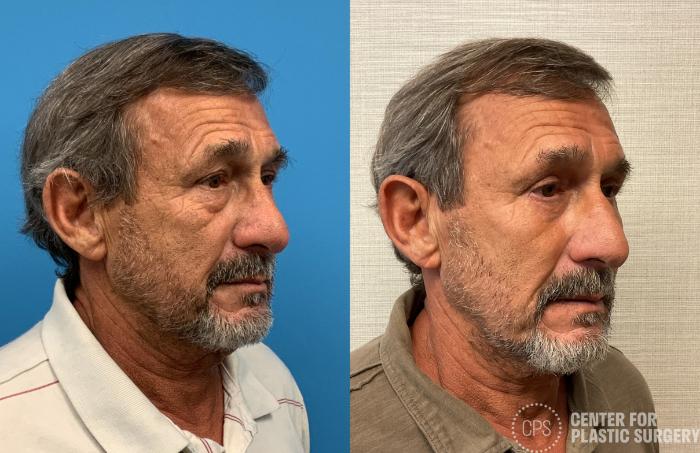 Eyelid Surgery Case 402 Before & After Right Oblique | Chevy Chase & Annandale, Washington D.C. Metropolitan Area | Center for Plastic Surgery