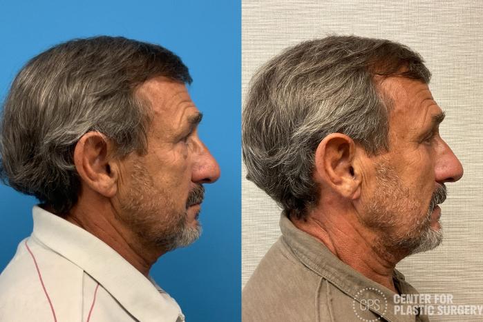 Eyelid Surgery Case 402 Before & After Right Side | Chevy Chase & Annandale, Washington D.C. Metropolitan Area | Center for Plastic Surgery