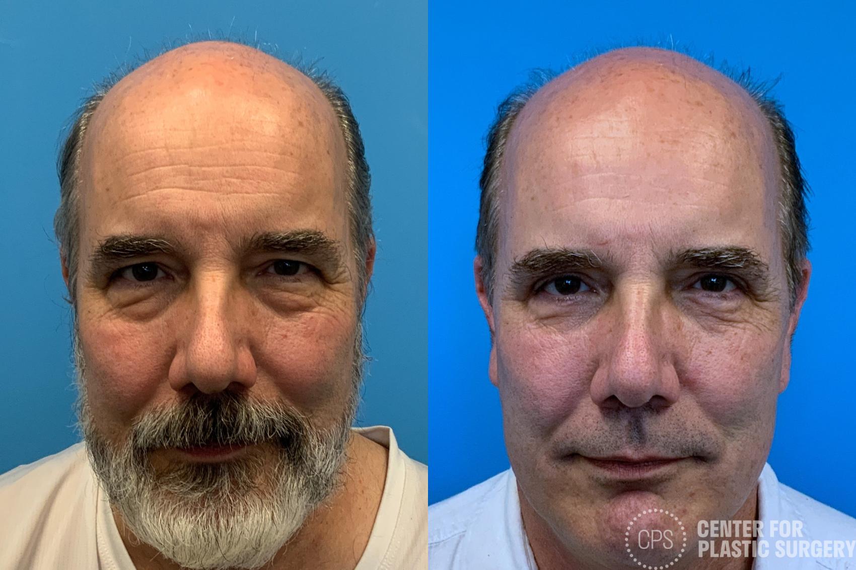Eyelid Surgery Case 409 Before & After Front | Chevy Chase & Annandale, Washington D.C. Metropolitan Area | Center for Plastic Surgery
