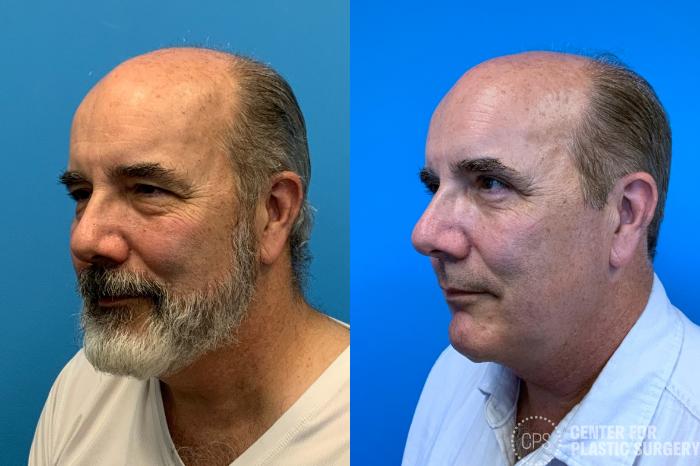 Eyelid Surgery Case 409 Before & After Left Oblique | Chevy Chase & Annandale, Washington D.C. Metropolitan Area | Center for Plastic Surgery