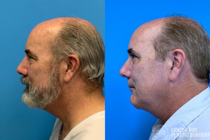 Neck Lift Case 409 Before & After Left Side | Chevy Chase & Annandale, Washington D.C. Metropolitan Area | Center for Plastic Surgery
