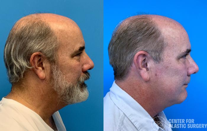 Neck Lift Case 409 Before & After Right Side | Chevy Chase & Annandale, Washington D.C. Metropolitan Area | Center for Plastic Surgery