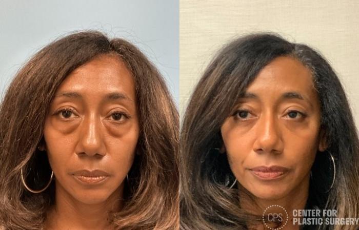 Eyelid Surgery Case 418 Before & After Front | Chevy Chase & Annandale, Washington D.C. Metropolitan Area | Center for Plastic Surgery