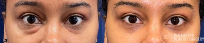Eyelid Surgery Case 437 Before & After Front | Chevy Chase & Annandale, Washington D.C. Metropolitan Area | Center for Plastic Surgery