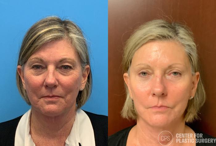 Facelift Case 404 Before & After Front | Chevy Chase & Annandale, Washington D.C. Metropolitan Area | Center for Plastic Surgery
