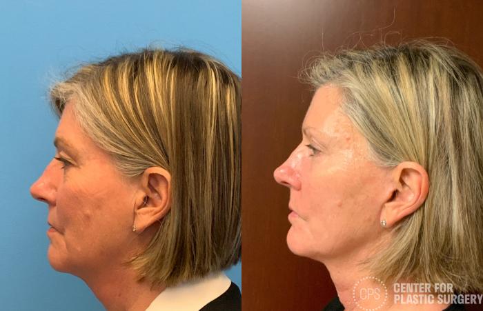 Facelift Case 404 Before & After Left Side | Chevy Chase & Annandale, Washington D.C. Metropolitan Area | Center for Plastic Surgery