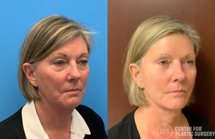 Eyelid Surgery Case 404 Before & After Right Oblique | Chevy Chase & Annandale, Washington D.C. Metropolitan Area | Center for Plastic Surgery