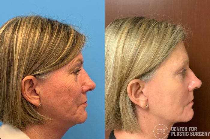 Facelift Case 404 Before & After Right Side | Chevy Chase & Annandale, Washington D.C. Metropolitan Area | Center for Plastic Surgery