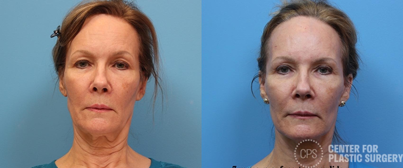 Facelift Case 1 Before & After Front | Chevy Chase & Annandale, Washington D.C. Metropolitan Area | Center for Plastic Surgery