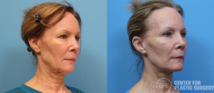 Facelift Case 1 Before & After Right Oblique | Chevy Chase & Annandale, Washington D.C. Metropolitan Area | Center for Plastic Surgery