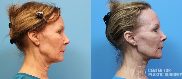 Facelift Case 1 Before & After Right Side | Chevy Chase & Annandale, Washington D.C. Metropolitan Area | Center for Plastic Surgery