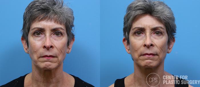 Facelift Case 10 Before & After Front | Chevy Chase & Annandale, Washington D.C. Metropolitan Area | Center for Plastic Surgery