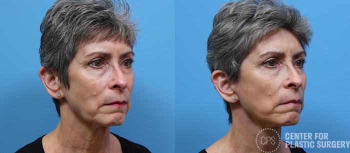Facelift Case 10 Before & After Right Oblique | Chevy Chase & Annandale, Washington D.C. Metropolitan Area | Center for Plastic Surgery