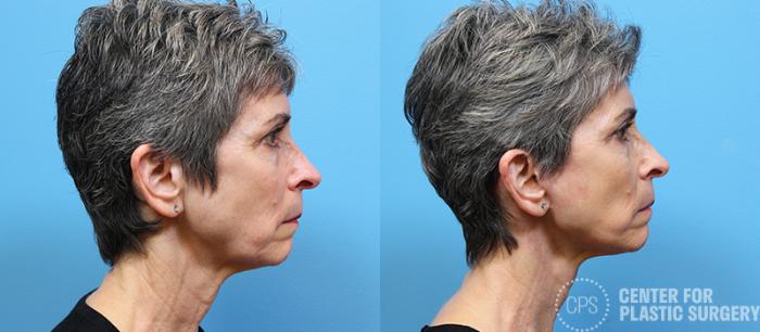 Facelift Case 10 Before & After Right Side | Chevy Chase & Annandale, Washington D.C. Metropolitan Area | Center for Plastic Surgery