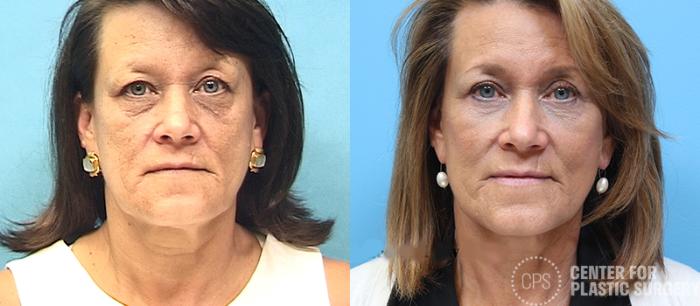 Facelift Case 11 Before & After Front | Chevy Chase & Annandale, Washington D.C. Metropolitan Area | Center for Plastic Surgery