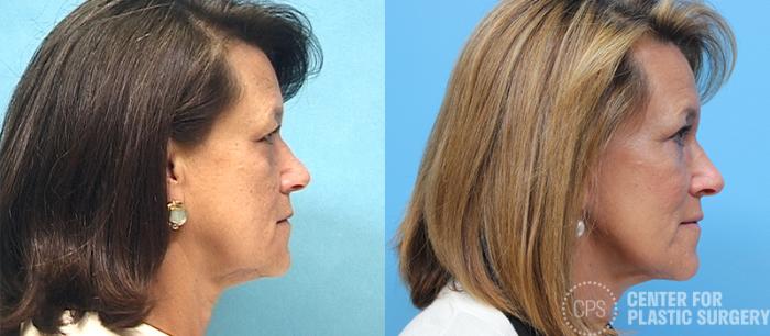 Facelift Case 11 Before & After Right Side | Chevy Chase & Annandale, Washington D.C. Metropolitan Area | Center for Plastic Surgery