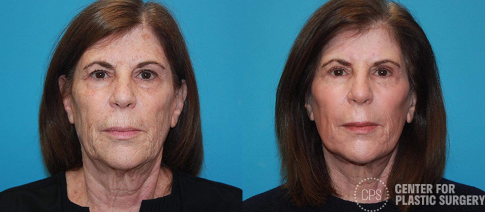 Skin Care Case 13 Before & After Front | Chevy Chase & Annandale, Washington D.C. Metropolitan Area | Center for Plastic Surgery