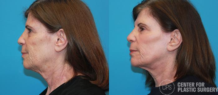 Skin Care Case 13 Before & After Left Side | Chevy Chase & Annandale, Washington D.C. Metropolitan Area | Center for Plastic Surgery