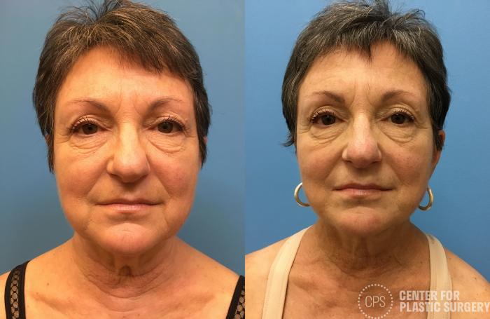 Facelift Case 162 Before & After Front | Chevy Chase & Annandale, Washington D.C. Metropolitan Area | Center for Plastic Surgery