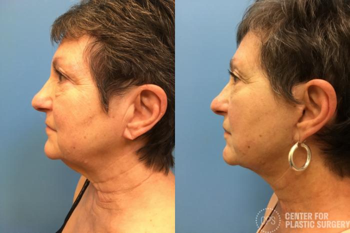 Neck Lift Case 162 Before & After Left Side | Chevy Chase & Annandale, Washington D.C. Metropolitan Area | Center for Plastic Surgery