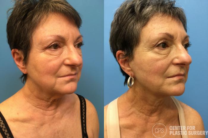 Facelift Case 162 Before & After Right Oblique | Chevy Chase & Annandale, Washington D.C. Metropolitan Area | Center for Plastic Surgery