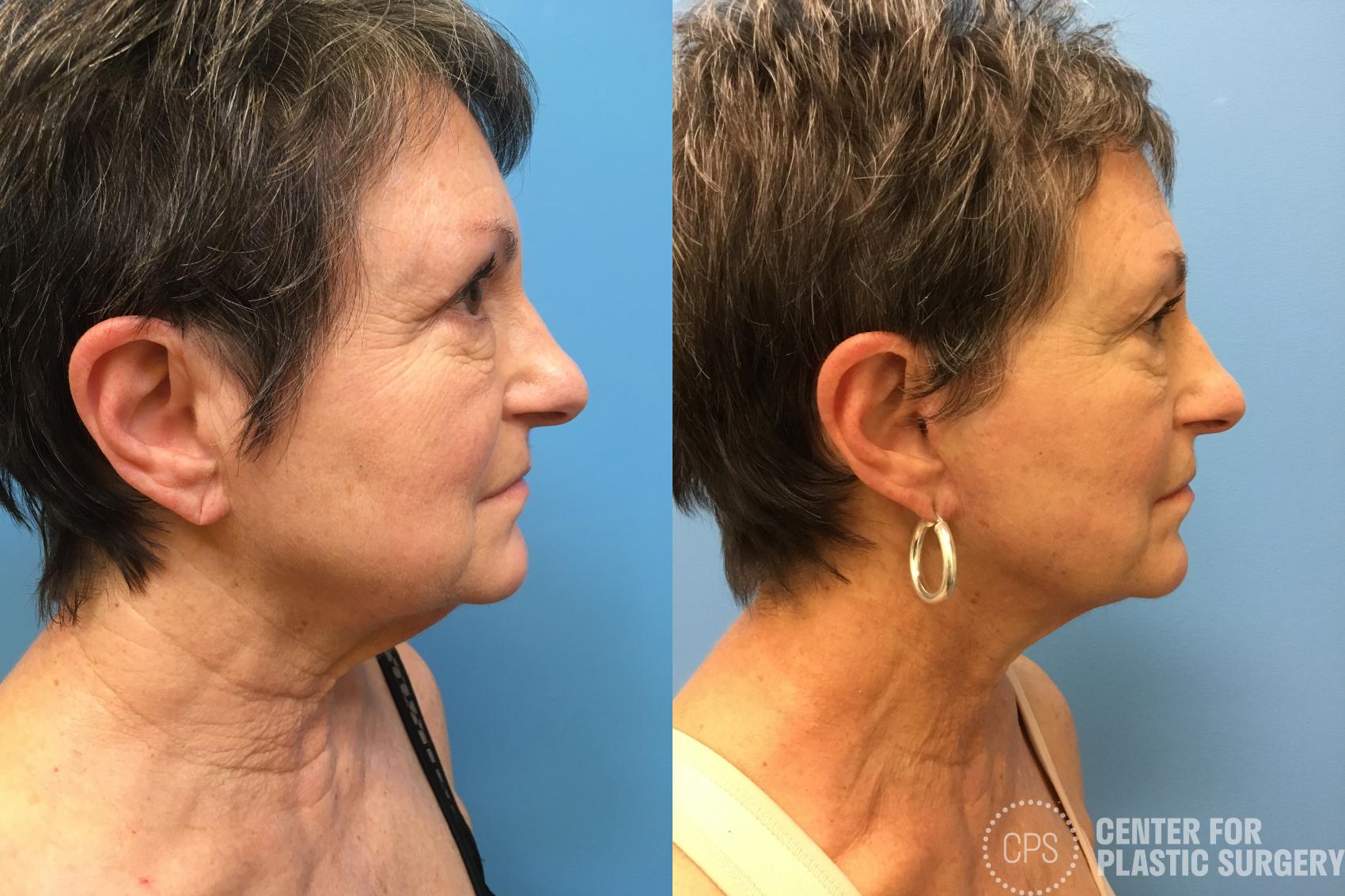 Facelift Case 162 Before & After Right Side | Annandale, Washington D.C. Metropolitan Area | Center for Plastic Surgery