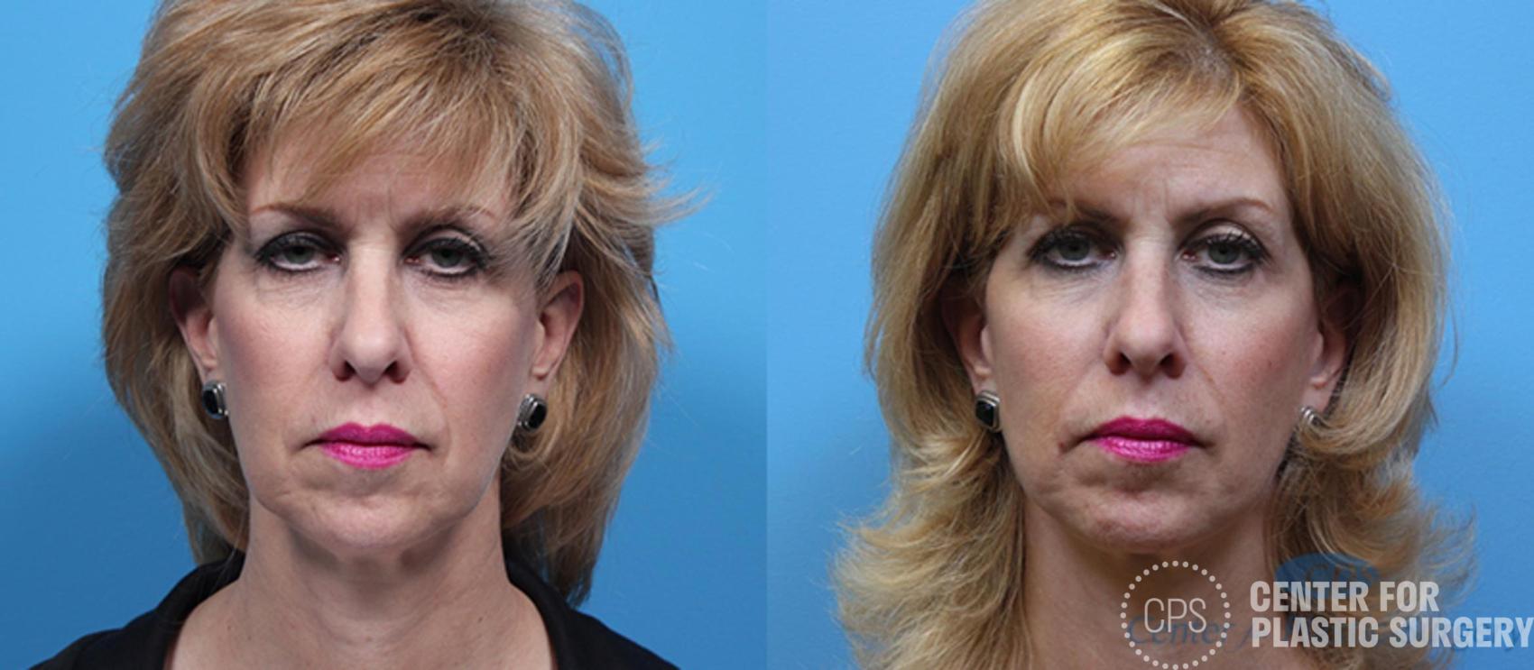 Facelift Case 185 Before & After Front | Annandale, Washington D.C. Metropolitan Area | Center for Plastic Surgery