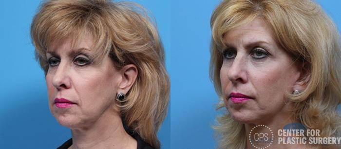 Facelift Case 185 Before & After Left Oblique | Chevy Chase & Annandale, Washington D.C. Metropolitan Area | Center for Plastic Surgery