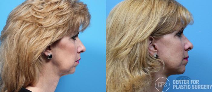 Facelift Case 185 Before & After Right Side | Chevy Chase & Annandale, Washington D.C. Metropolitan Area | Center for Plastic Surgery